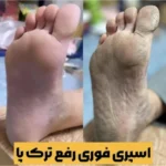 اسپری رفع ترک پا و لایه بردار راکو - تصویر 3